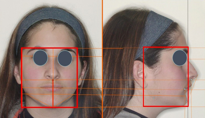 Análise morfovolumétrica da face